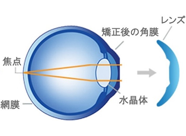 矯正後:翌朝レンズを外すと視力が改善
