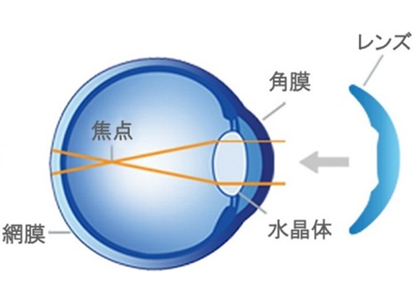 矯正前:寝る前にレンズを装用