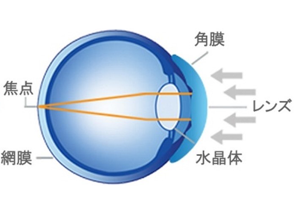 矯正中:角膜の形状を正常な屈折状態にする
